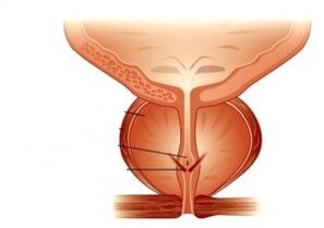 prostatitis and its drug treatment