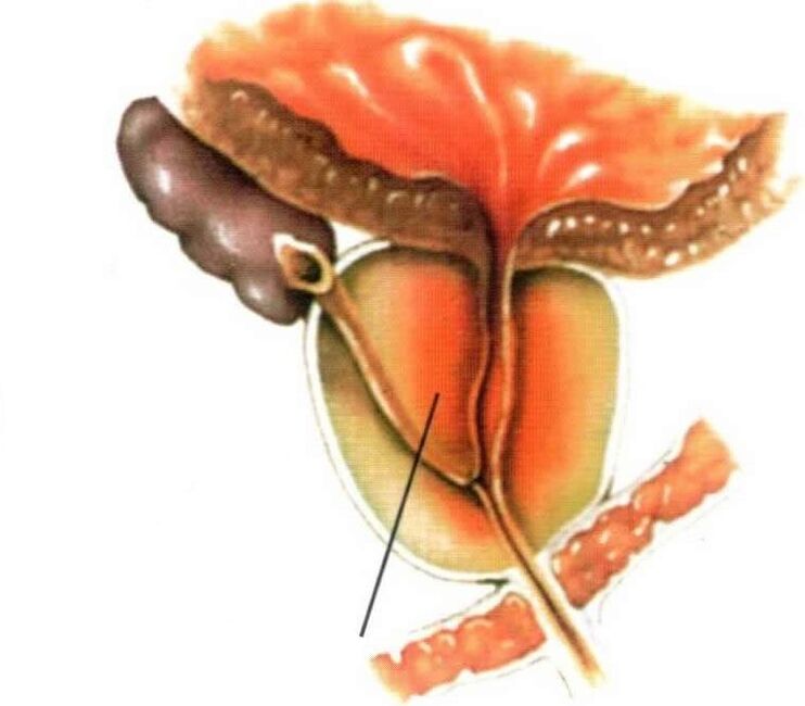 Inflammation of the prostate tissue in chronic prostatitis